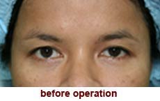 plastic-surgery-blepharoplasty